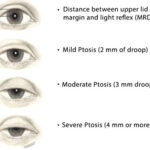 Droopy Eyelid (Ptosis) Treatment NYC