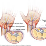 Physical Examination for Carpal Tunnel