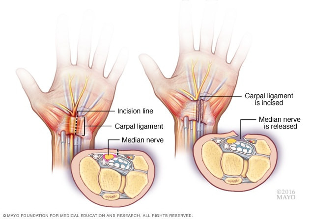 Physical Examination for Carpal Tunnel
