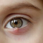 Close-up of an eye with a stye on the upper eyelid, showing redness and swelling