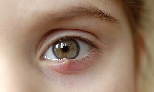 Close-up of an eye with a stye on the upper eyelid, showing redness and swelling