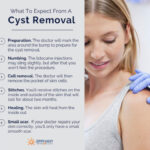 cyst removal procedure