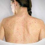 Womans back with shingles disease on skin